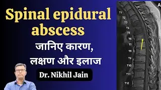 What's the Real Reason Behind Spinal Epidural Abscess Causes and Symptoms?