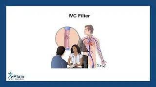 IVC Filter