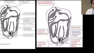 Retained products of conception or uterine AVM??  Dr. Aarti Sekhar