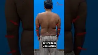Male Back Liposuction Result | Back Fat Removal at Divine #shortsfeed