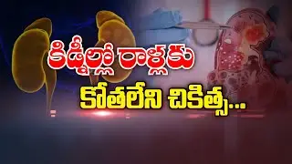 కిడ్నీల్లో రాళ్లకు కోతలేని చికిత్స...  | Lithotripsy for Kidney stones | Sukhibhava | ETV Life