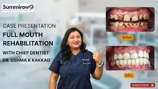 Full Mouth Rehabilitation Case Study | Dr. Ushma k Kakkad Dental Restoration Approach