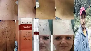 Wipeoff Tags & Moles Remover | Honest Review
