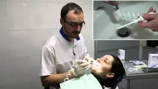 Виды насадок для ирригатора SoWash и как пользоваться ирригатором.