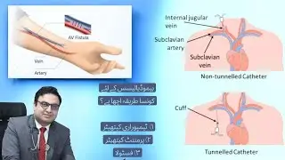 Which Hemodialysis access is better, Arteriovenous fistula, Permacath or temporary catheter?