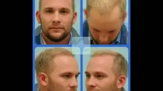 Dallas Hair Transplant Megasession Video Transformation