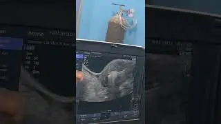 Trans cervical microwave ablation for adenomyosis 