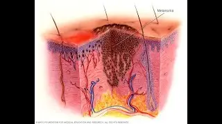 Malignant Melanoma a type of skin cancer and it's treatment