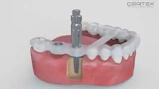 Cortex Guided Surgery &ndash; Virtual Planning, Customized Components & Universal Surgical Kit