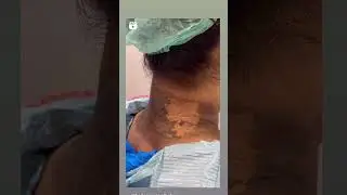 Neck carbon laser treatment at #bellacareaesthetics #lahore #lines #wrinkles  #defencedayofpakistan