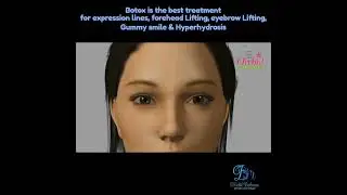 Botox by Dr Nabil Bahsoun