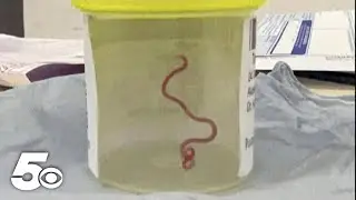 Doctors find a worm in a woman's brain in Australia