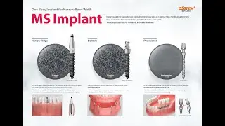 MS Implant Narrow Ridge Surgical Sequence