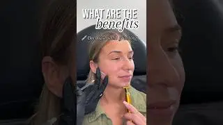 masseter botox benefits 💉 #masseterbotox #teethgrinding #tmj #botox
