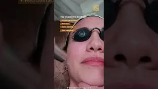 Acne Scar Removal