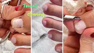 Deep Toenail Cleaning &ndash; So Satisfying! 🔥💅 #NailCare #howtocutnails #nailcleaning #healthynails