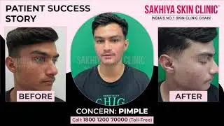 Best Acne & Pimple Treatment | Real Patient Results at Sakhiya Skin Clinic