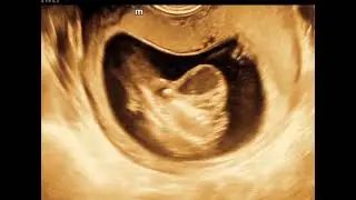 cystic lymphangioma fetal ultrasound