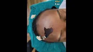 9 сеансов микронидлинга #уходзакожей #микронидлинг #микронидлинглица #доипосле #допосле