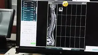 MRI LS SPINE PRINTING PROCEDURE IN UMR 580 1.5 T (UNITED IMAGING)