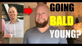 Going BALD Young | Debunking the Biggest FEARS