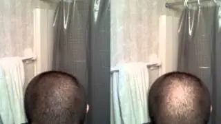 Dermmatch -  Hairback eu
