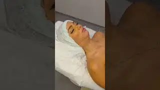 Double chin +jawline liposuction ✅1ml chin filler ✅