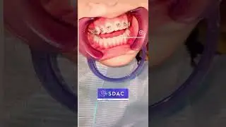 Orthodontics #braces #dentalclinic #bracesupdate #sdac #smiledental #teethalignment