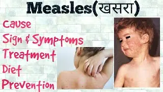 Measles(खसरा) Causes, treatment, sign & symptoms,Diet, Prevention