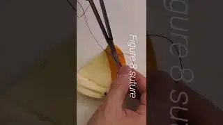 Figure 8 suture & Hidden X suture