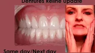 Dentures Update: Soft Reline Update!  Same- Next Day