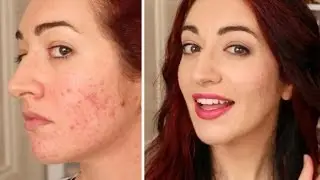 Pop Of PINK! Makeup Tutorial + How To Cover Acne Scarring With BB Cream!