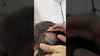 Mini protese capilar