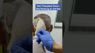Hair Transplant Donor Area Dressing on 3rd Day...