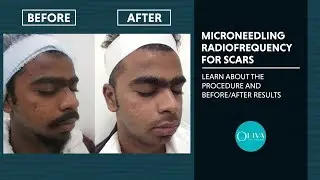 Micro-needling Radiofrequency(RF) Treatment, Before And After Results - Oliva Clinic