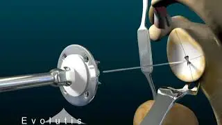 Evolutis   Reverse Shoulder surgery Animated Version