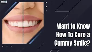 Why do some smiles show too much gum?