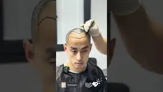 Hairline Design Planning for an Asian Male Patient - Dr. Resul YAMAN