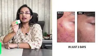 Face Mask For Acne Prone Skin | Salicylic Acid & Niacinamide | SkinQ Acne Control Mask