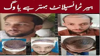 Hair transplant in faisalabad | Best hair transplant surgeon in pakistan | best hair transplant |
