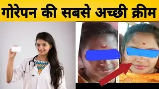 गोरेपन की सबसे अच्छी क्रीम, skin whitening cream,  no side effects