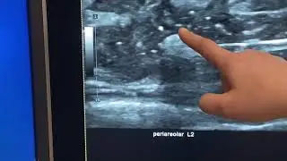 Breast Tumor marker clip Deployments, TUMARK Professional