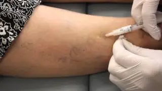 Sclerotherapy at Sanova Dermatology