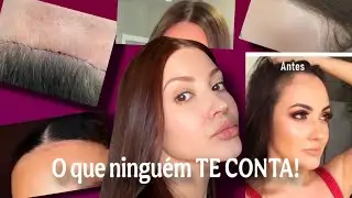 O resultado da Frontoplastia 7 anos depois! O que ninguém te conta sobre reduzir a TESTA! 