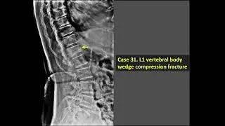 L1 Vertebral Body Wedge Compression Fracture (X-Ray)