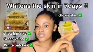 BEST BODY SOAP TO CLEAR WHITE PATCHES, GREEN VEINS, STRETCH MARKS, DARK SPOTS AND LIGHTEN UP SKIN |🌷