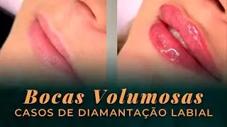 Diamanta&ccedil;&atilde;o Labial: Tudo Sobre o Procedimento!