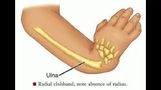 Radial club hand; Radial Dysplasia congenital deformity, radius bone is absent or underdeveloped