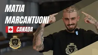 Hair Transplant in Turkey | Matia Marcantuoni Hair Transplant Review | Hair Center of Turkey