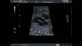 TOSHIBA APLIO-80 (2003) #LVOT #FETALECHOCARDİOGRAPHY #LEFTVENTRICULAROUTFLOW